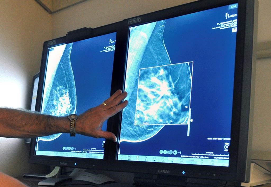 Breast Cancer Is Rising Among U.s. Young Women Even As Deaths Drop: Study