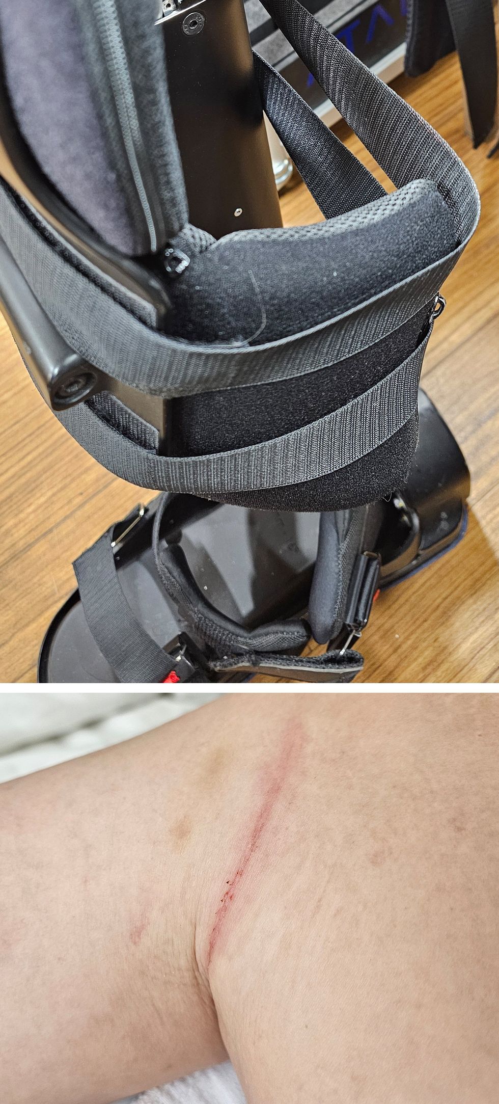 Knee brace with straps and a leg showing a fresh, red incision scar.