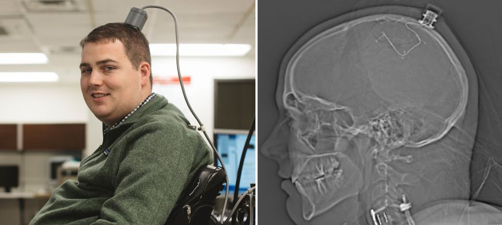 Two images. The first is a photo of a man sitting in a wheelchair; attached to the top of his head is a device with a cable attached. The second is a medical image showing the location of electrodes in the brain.