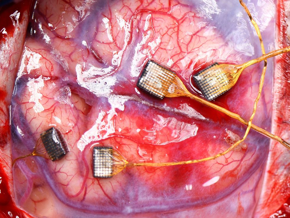 Two photos. The first shows a man sitting in a chair with a large robotic arm extending in front of him. The second is a close-up of implants on the surface of a brain.